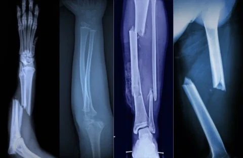 Best Arthroscopic Surgeon in Kolkata – Dr. Reet Mukhopadhyay Offers Expert Arthroscopy for Ligament and Joint Repairs!