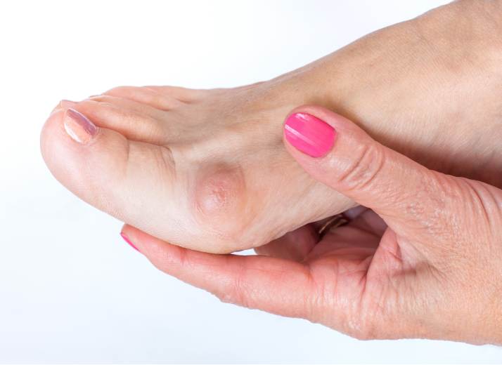 Complications of Bunion Surgery: Risks and What to Expect Complications of Bunion Surgery: Risks and What to Expect