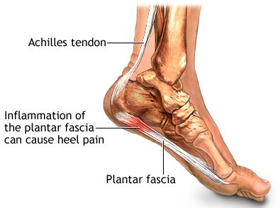 Plantar Fasciitis Natural Treatment | Effective Relief & Healing Solutions