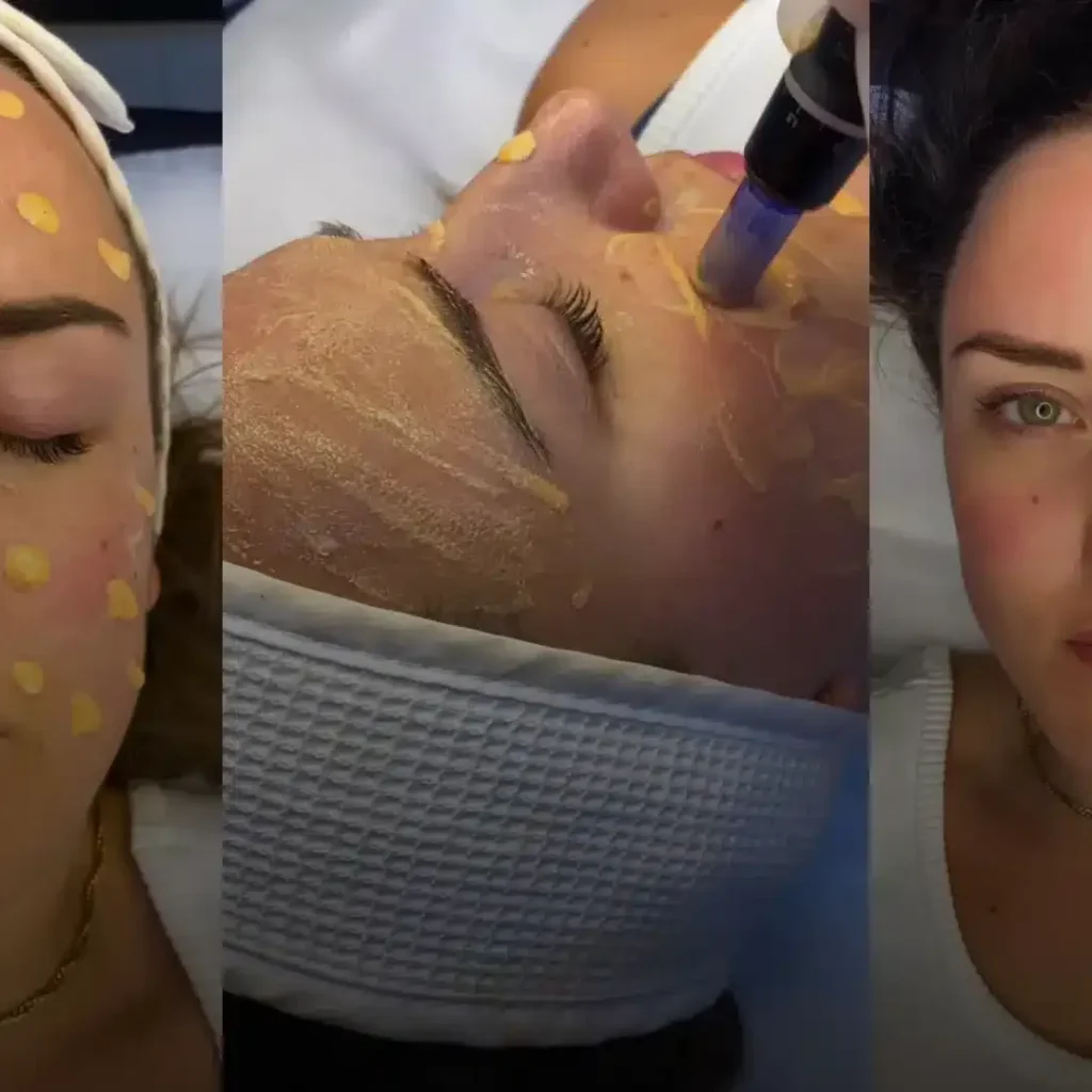 Scar Camouflage Treatment in Dubai: Restore Confidence
