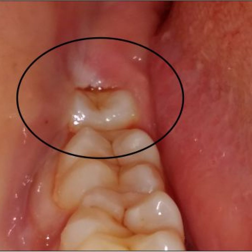 Discover Invisible Aligners in Rajkot for a Subtle Smile