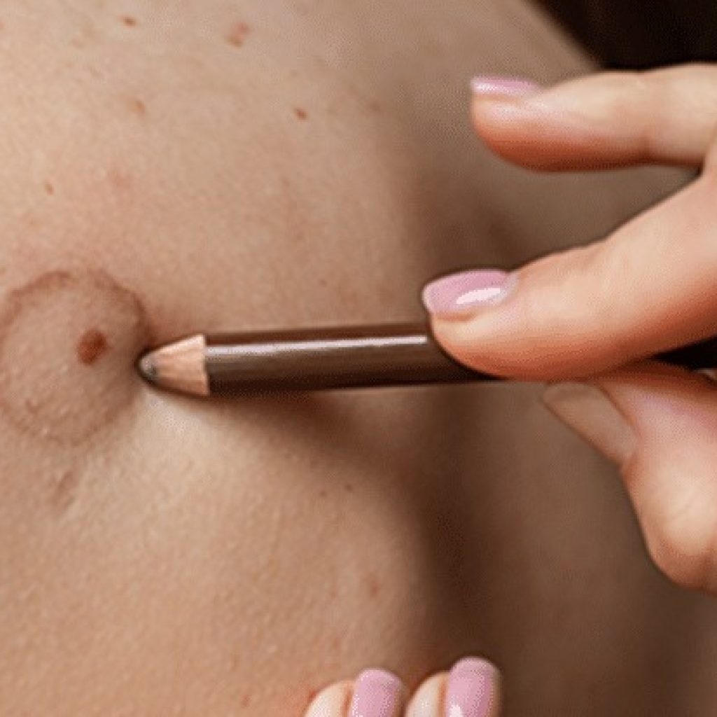 Discreet Scar Camouflage Solutions in Dubai Discreet Scar Camouflage Solutions in Dubai