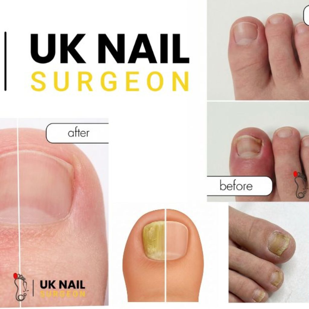 Gentle solutions for young toenail discomfort