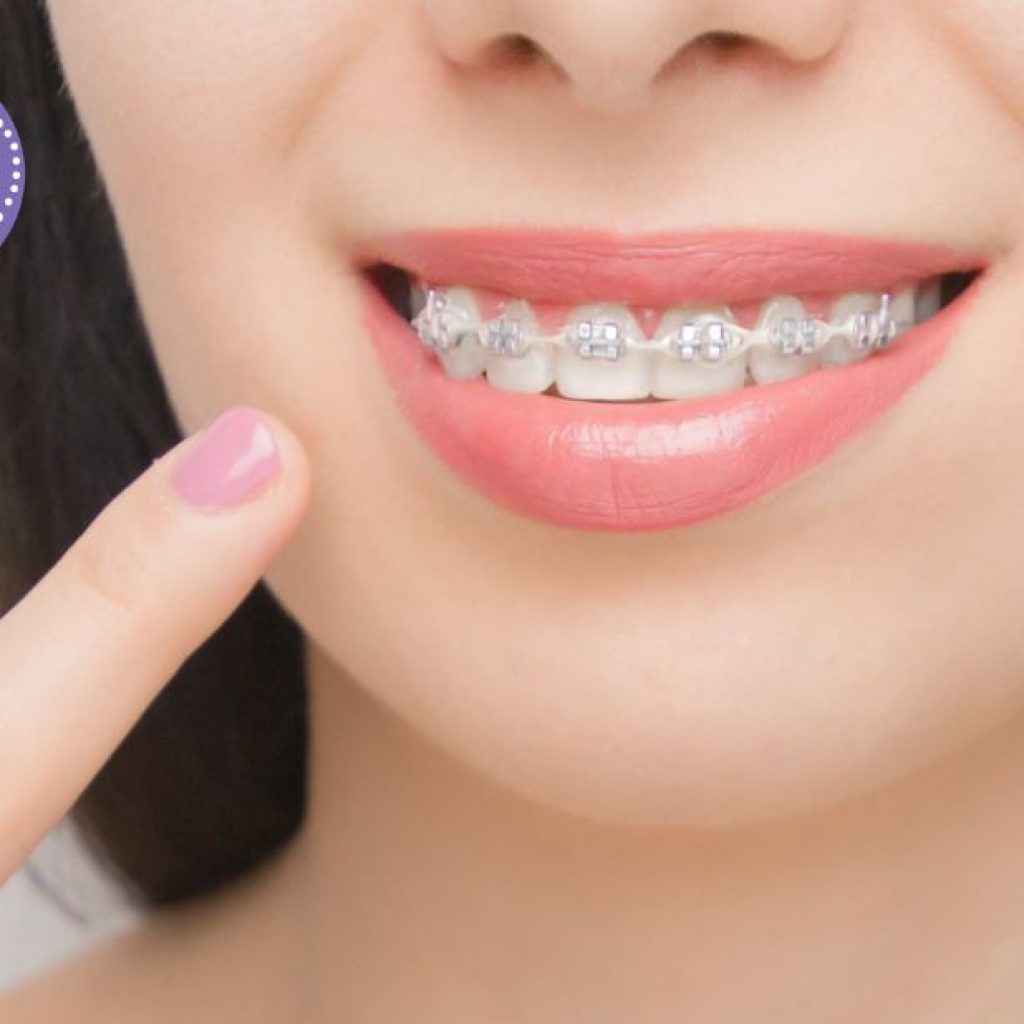Somriure alineat amb brackets a Gines