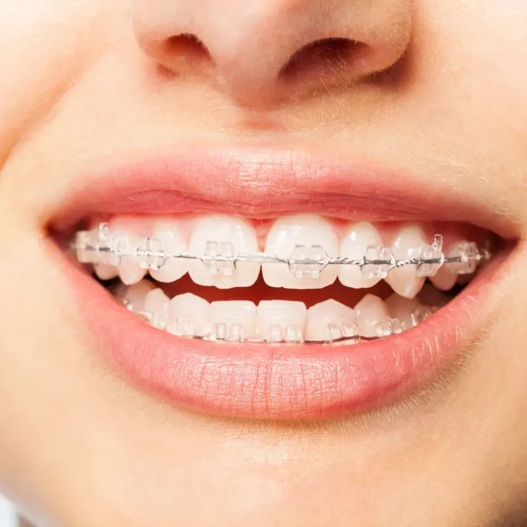 What Affects the Price of Clear Aligners in the UK