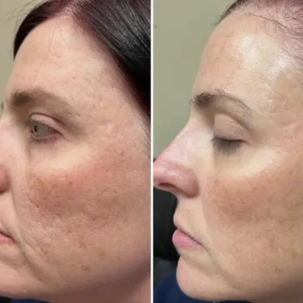 Nano Needling Facial For Acne | Skinbeautyandbeyond.com