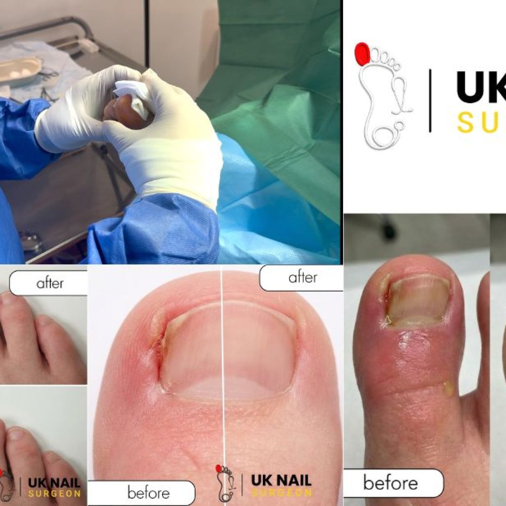 Treating Nail Infections: A Gentle, Effective Procedure and Aftercare