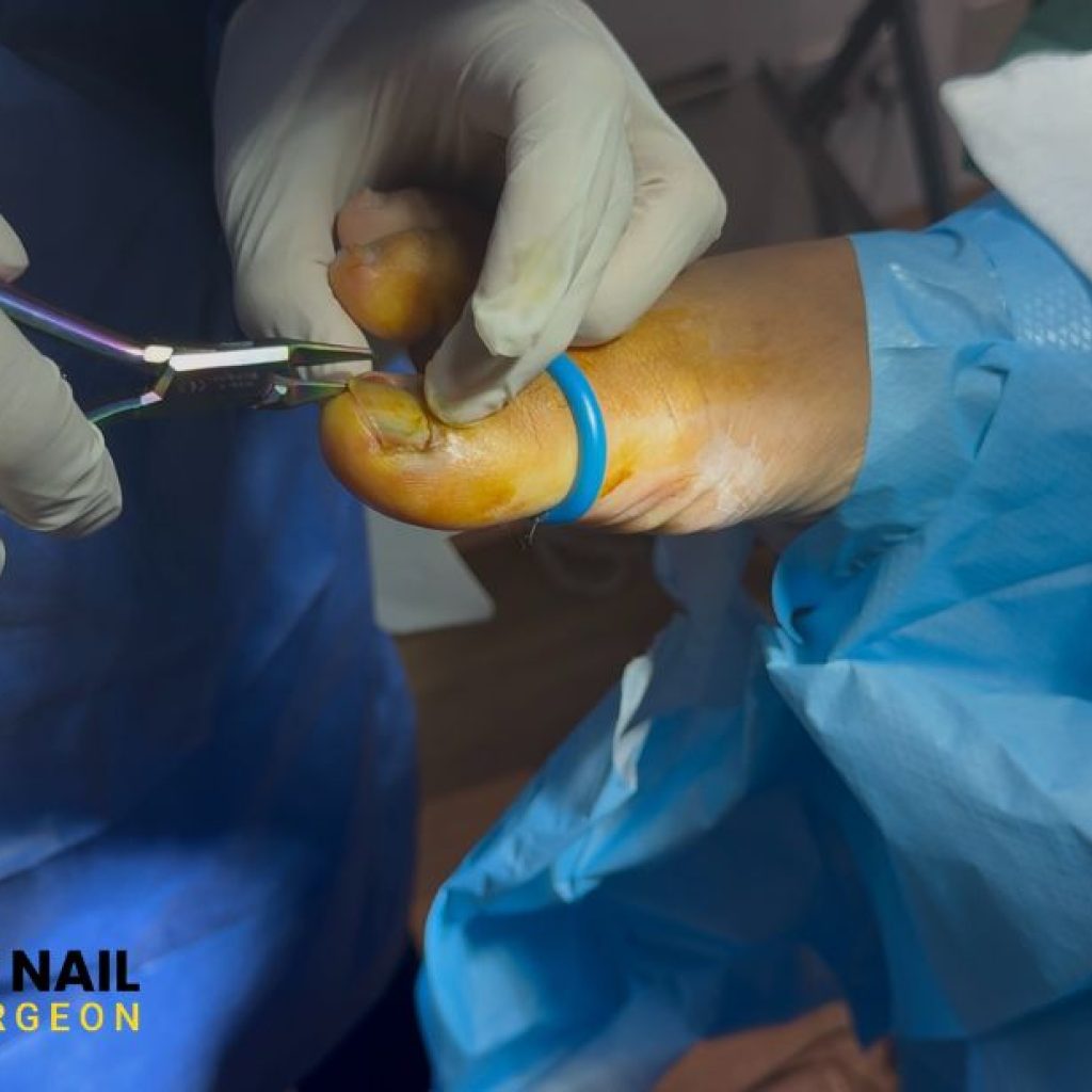 Relieve Pain Fast: Safe Toenail Care and Removal Options